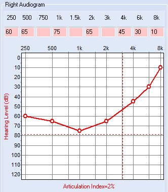 Sample Audiogram using HL